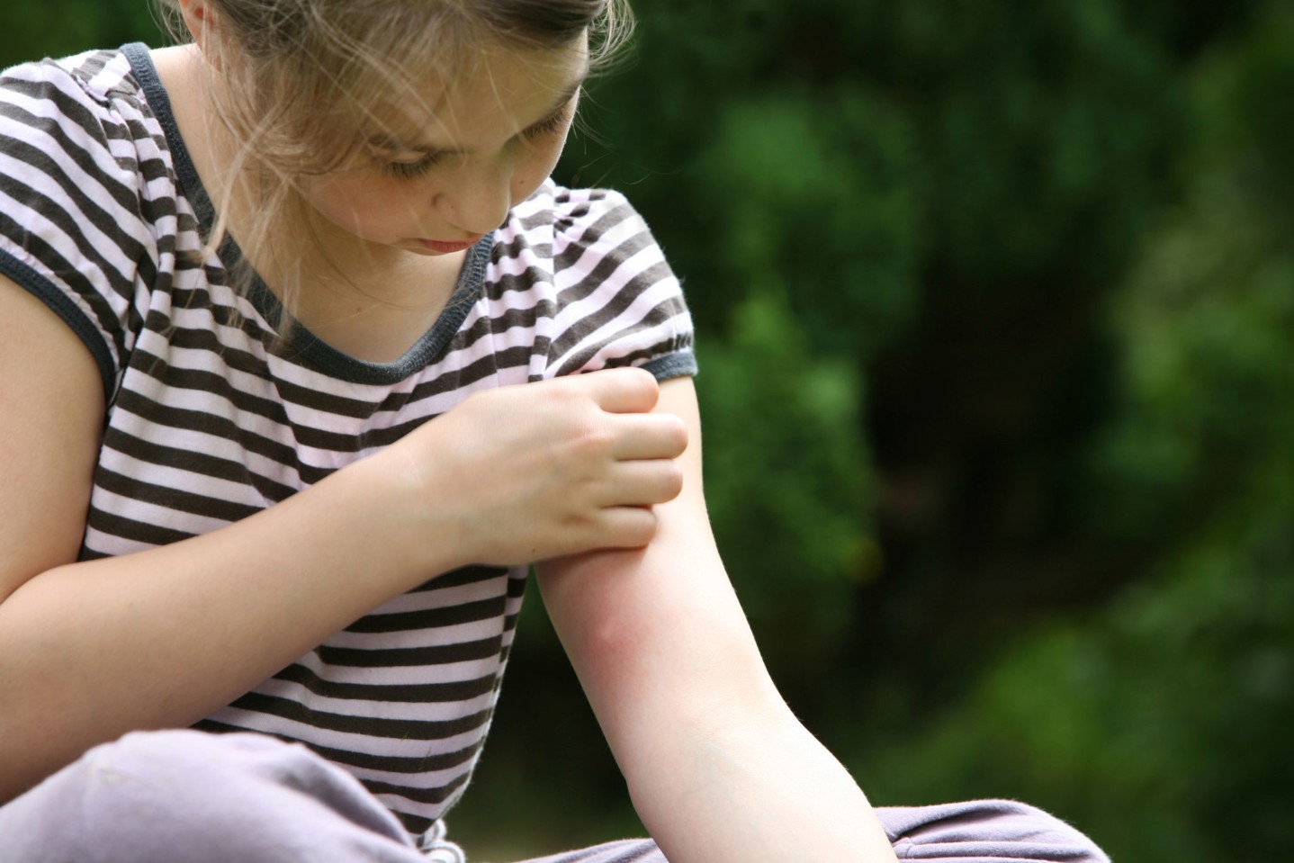 insect-sting||running water over burn