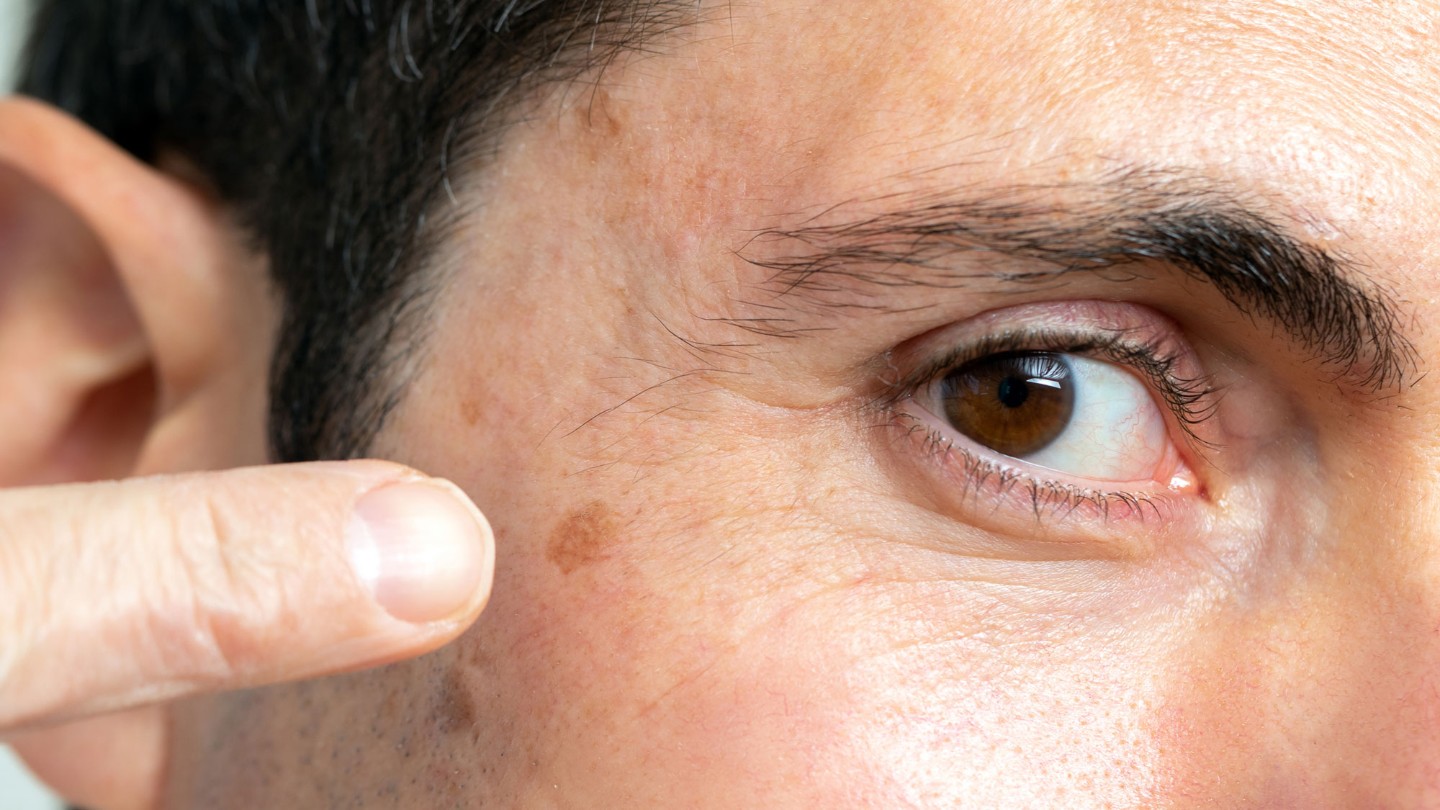 Pointing out a mole on the face that might need skin cancer treatment