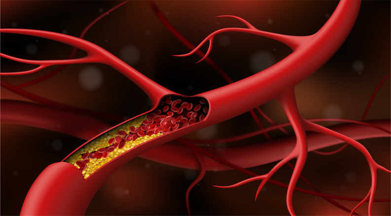 Artery blocked by cholesterol. Vector illustration